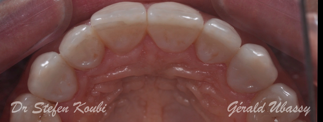 Veneers Dr Koubi/Ubassy